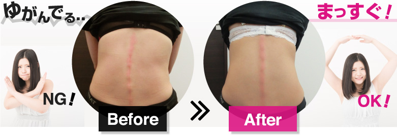 背骨の歪み BeforeAfter