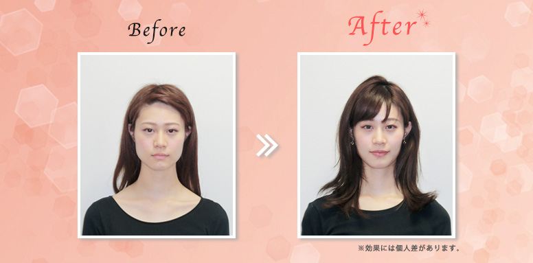 ���� BeforeAfter