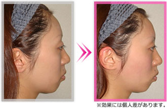 3D小顔矯正とはimg
